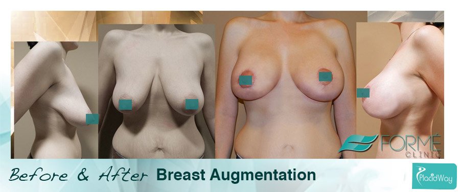 Before After Breast Augmentation Prague