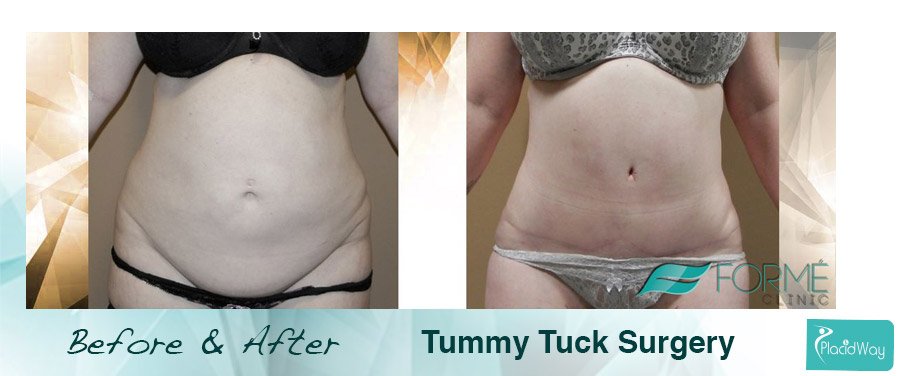 Before and After Tummy Tuck Surgery Patient Result 