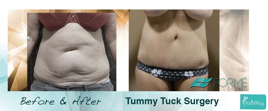 After Abdominoplasty - Patient Result - Czech Republic