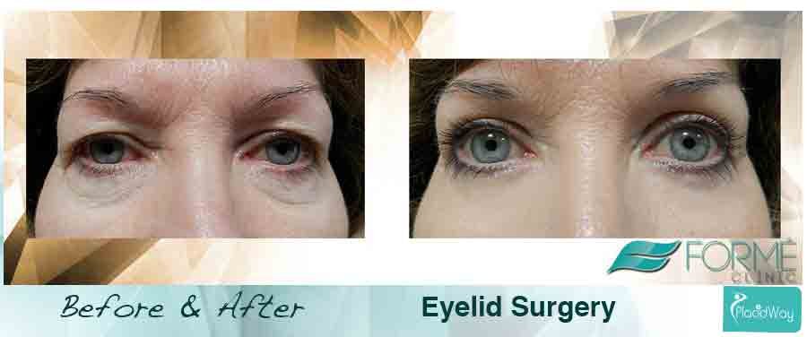 After Blepharoplasty Forme Clinic Czech Republic