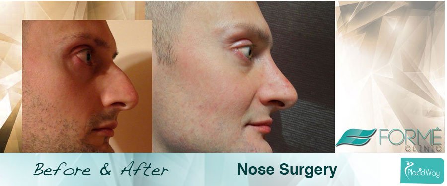 After Male Nose Surgery Result - Prague