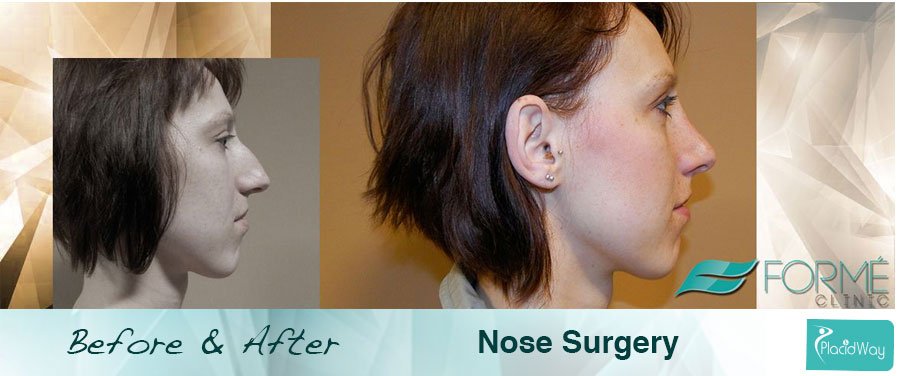 After Female Nose Surgery - Czech Republic