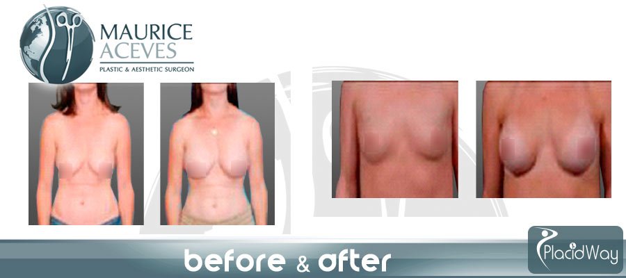 Before After Breast Augmentation Surgery Mexico