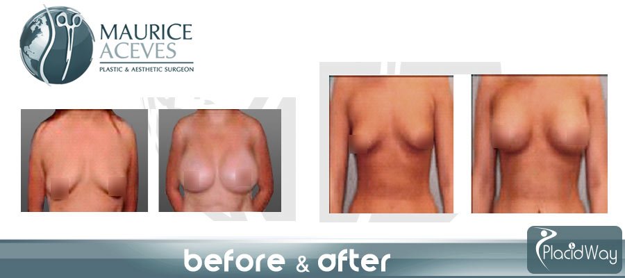 After Breast Implants Image Testimonial Mexico