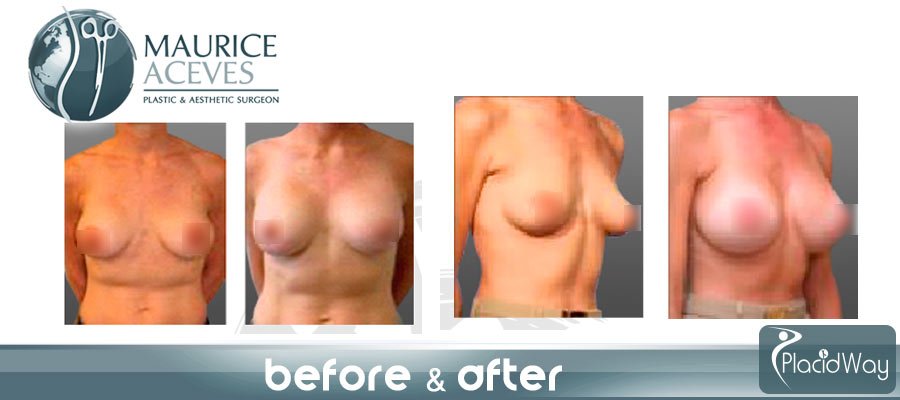 After Breast Enhancement Picture Mexicali 