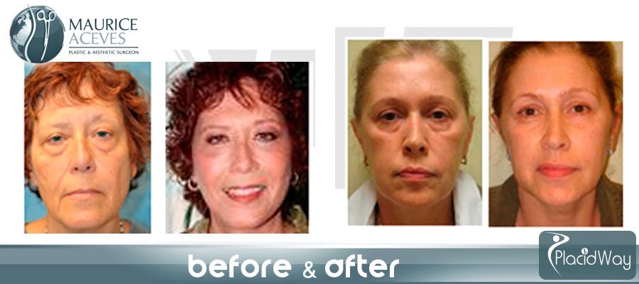 Mexicali Plastic Surgery