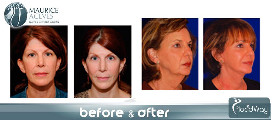amaya plastic surgery mexicali amaya plastic surgery mexicali