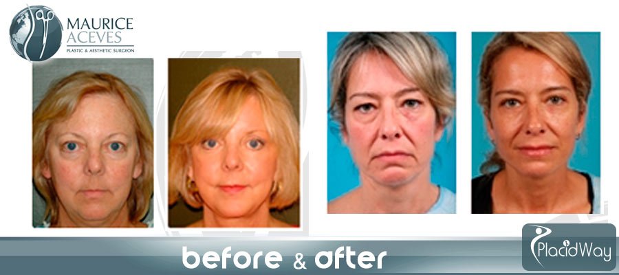 After Facelift Surgery Latin America