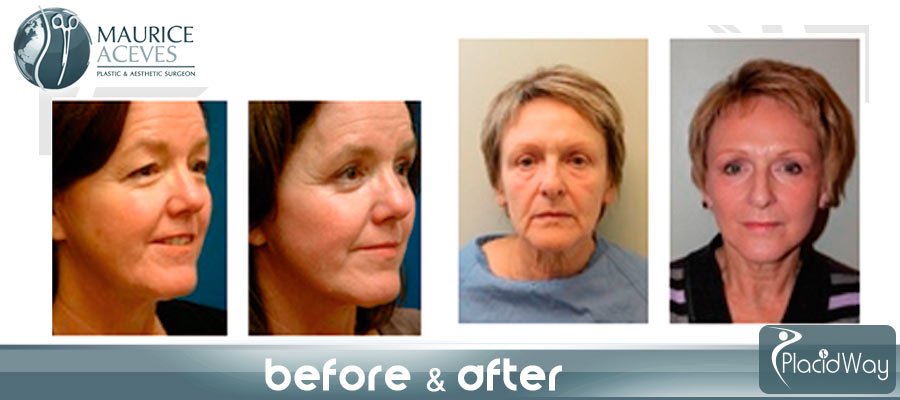 After Cosmetic Surgery Patient Picture Testimonial