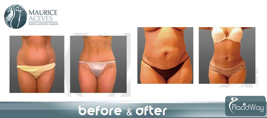 Before After Pictures Liposuction Surgery Mexicali, Mexico