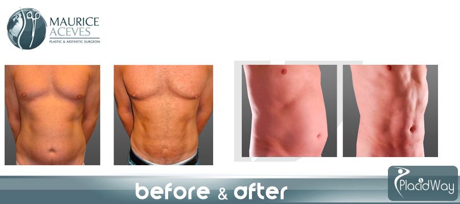 Before After Male Liposuction Picture - Mexico