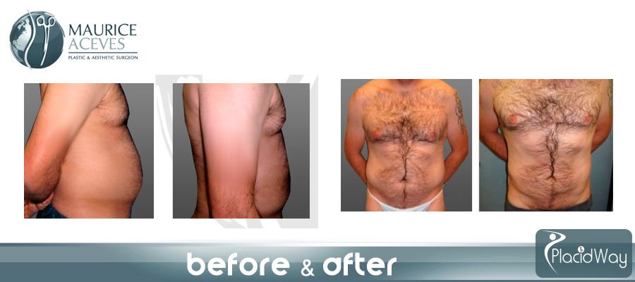 Before After Male Lipoplasty Image - Mexicali