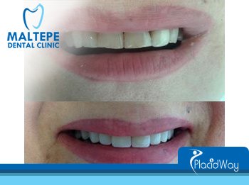 Emax Veneers Turkey