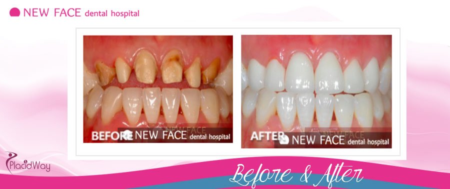 Before After Pictures Smile Restoration South Korea