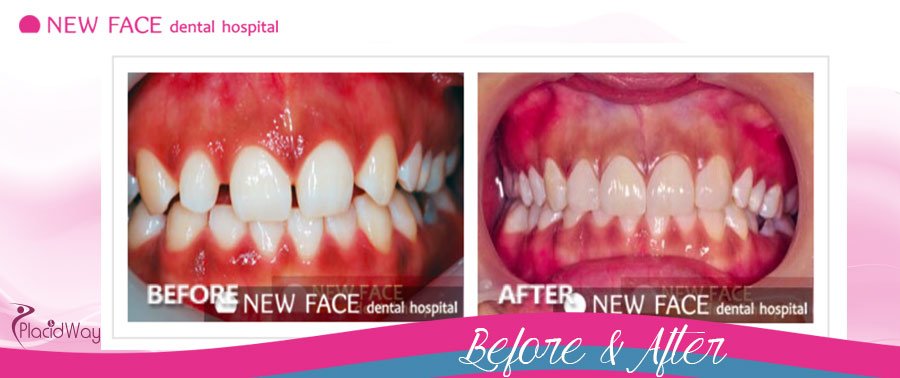After Dental Implants Patient Photos South Korea