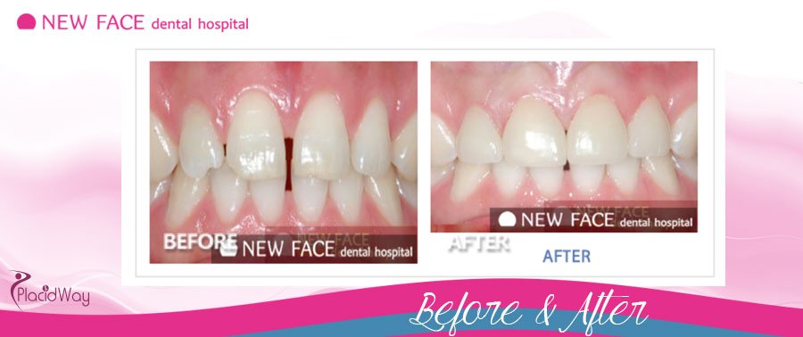 Before & After Total Esthetics Dental Treatment Seoul