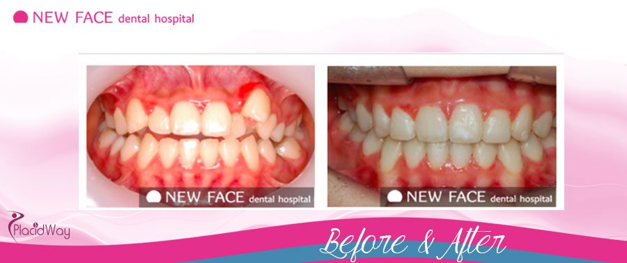 After Teeth Bleaching South Korea