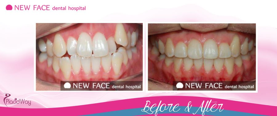 Before & After Testimonial  Orthodontics Seoul, South Korea
