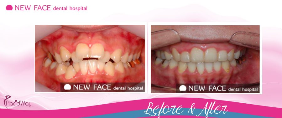 After Prosthodontics Pictures South Korea