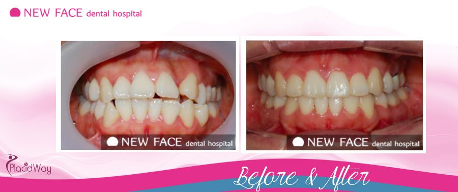 Braces - Cosmetic Dentistry - Seoul