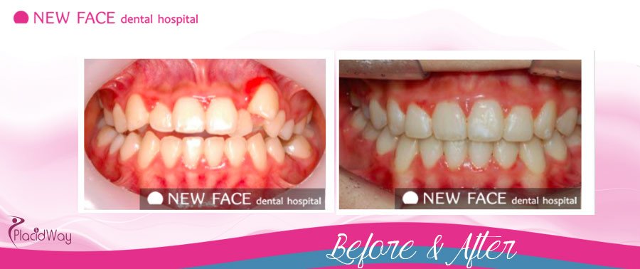 Before After Dentistry Treatment Asia