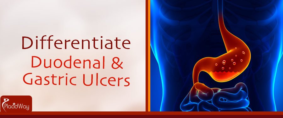 Differentiate Duodenal - Gastric Ulcers