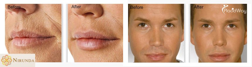 Before and After Images of Filler for Facial Rejuvenation in Thailand, Nirunda Clinic, Bangkok