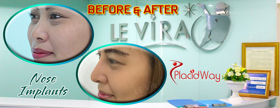 Before and After Pictures Nose Implants in Bangkok, Thailand