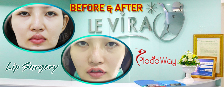 Before and After Lip Surgery in Bangkok, Thailand