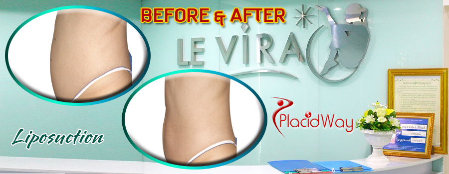 Before and After Liposuction Surgery in Bangkok, Thailand