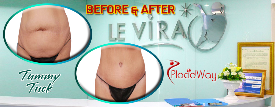 Before and After Tummy Tuck Surgery at Le Vira Clinic, Thailand