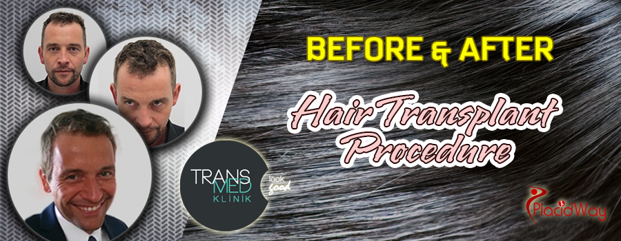 Before and After Hair Transplant Procedure in Turkey