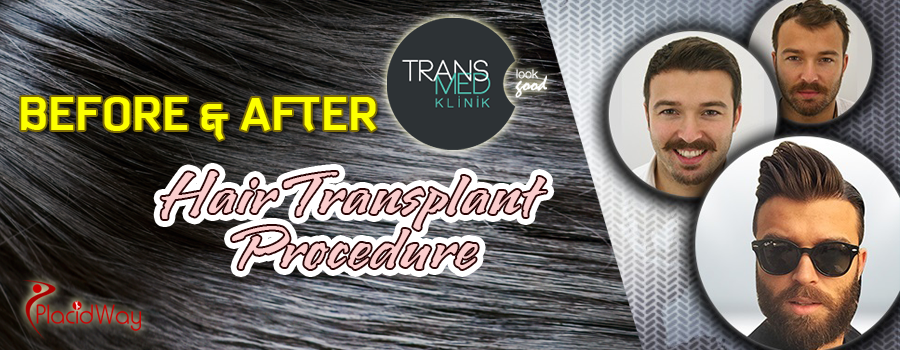 Before and After Pictures of Hair Transplant in Transmed Klinik, Turkey