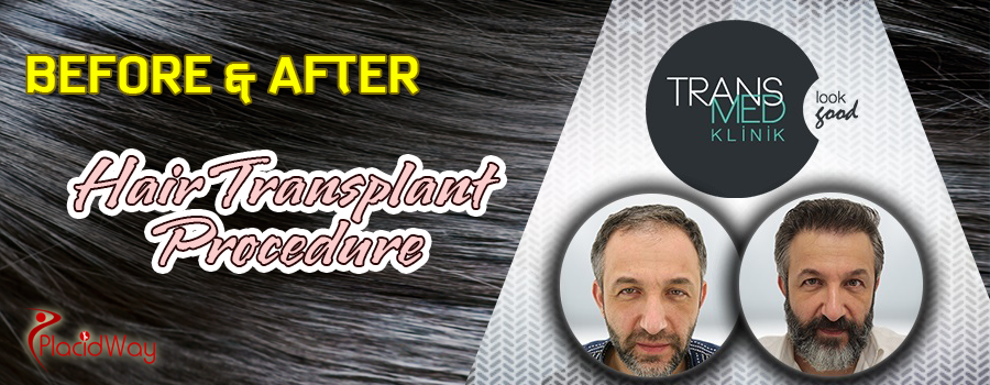 Hair Transplantation Before and After Images Istanbul Turkey