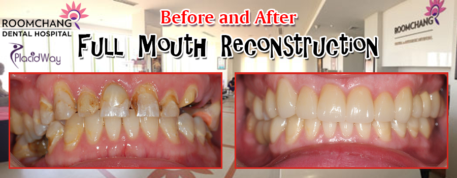 Before and After Full Mouth Reconstruction in Phnom Penh, Cambodia