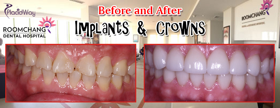 Before And After Dental Implants and Crowns in Cambodia