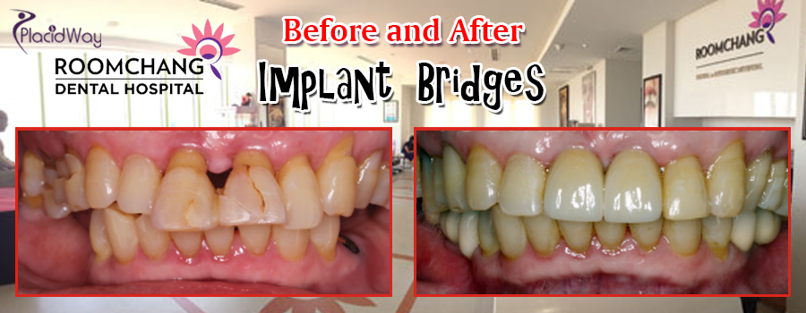 Before and After Dental Implants Bridge in Roomchang Dental Hospital in Cambodia