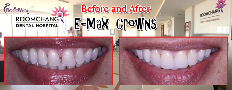 E-Max Crowns in Cambodia Before and After Pictures