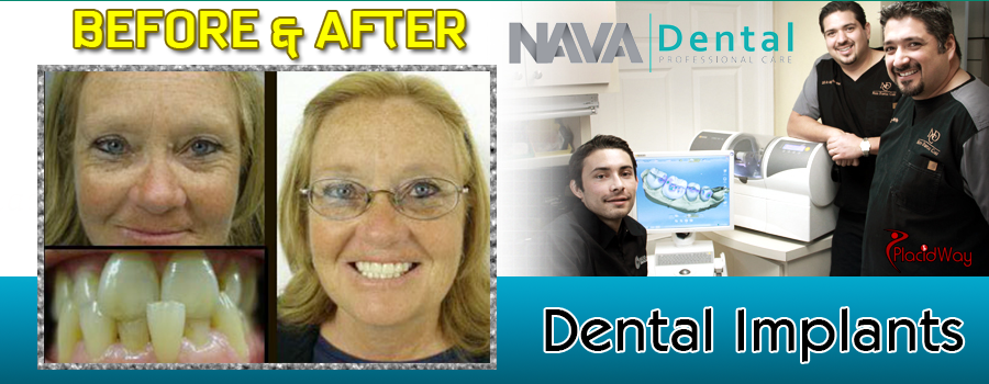 Before and After Dental Implants in Los Algodones Mexico 