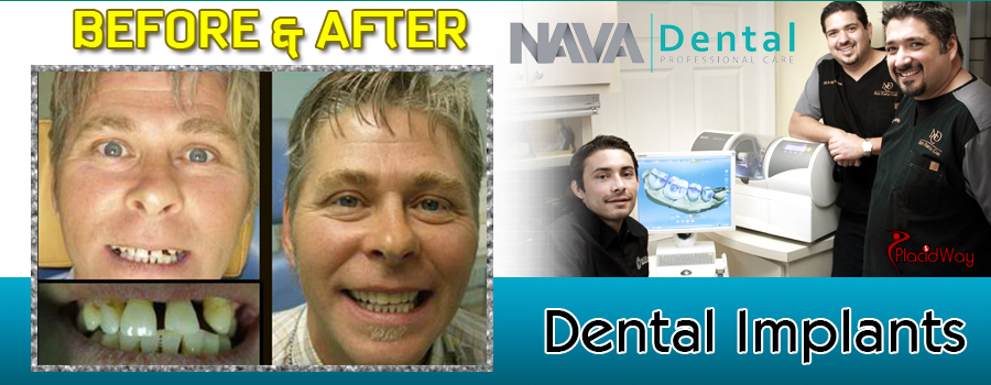 Before and After Pictures Dental Implants at Nava Dental Care