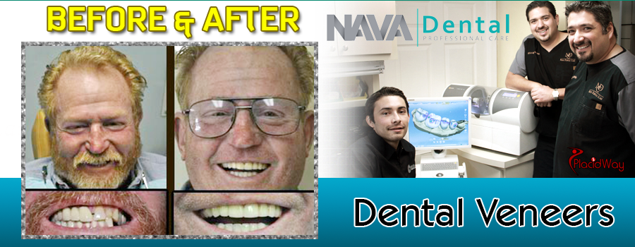 Dental Veneers Before and After Results in Mexico at Nava Dental Care