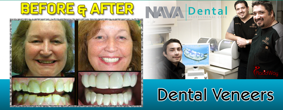 Before and After Dental Veneers in Mexico