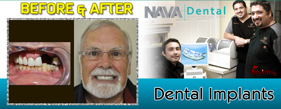 Patient Result Dental Implants in Los Algodones, Mexico at Nava Dental Care