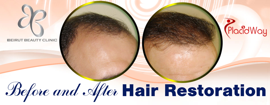 Before and After Hair Transplant Procedure in Lebanon