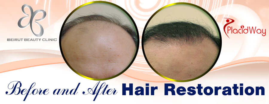Before and After Pictures of Hair Restoration at Beirut Beauty Clinic