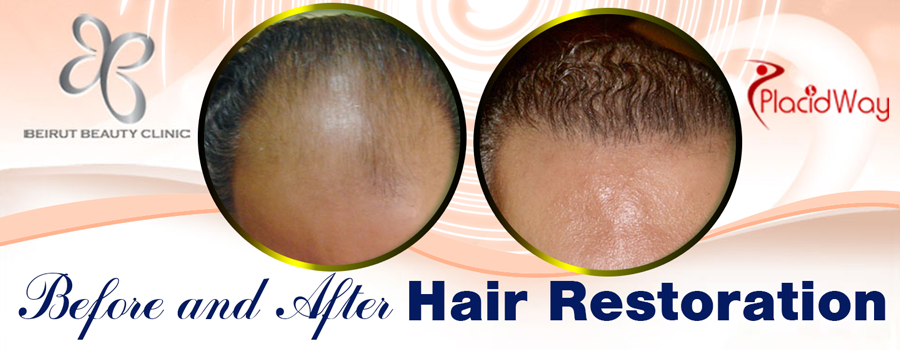 Hair Restoration Before and After Images Beirut Lebanon