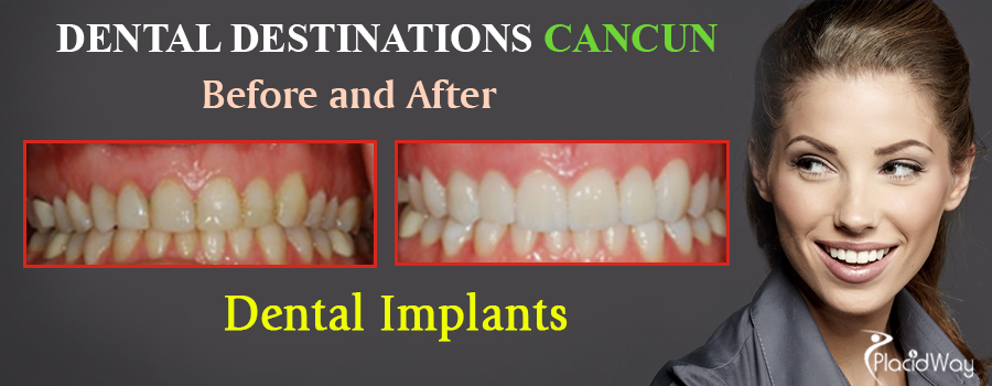 Before and After Dental Implants in Mexico