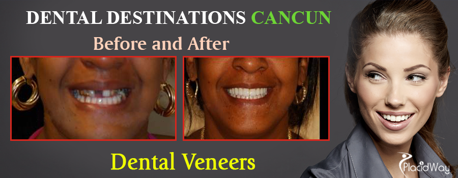 Before and After Dental Veneers in Mexico