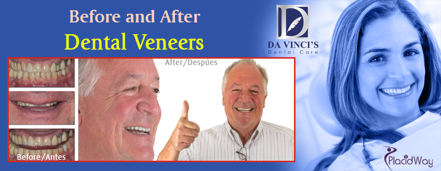 Before and After Dental Veneers in Costa Rica