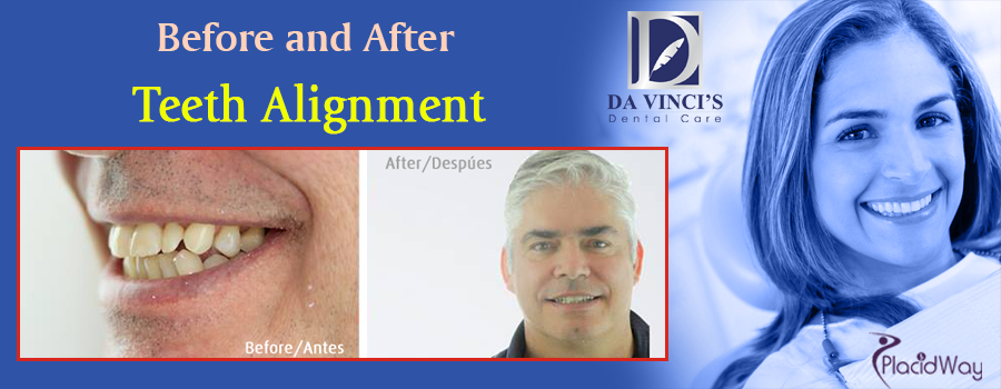 Before and After Teeth Alignment in Costa Rica